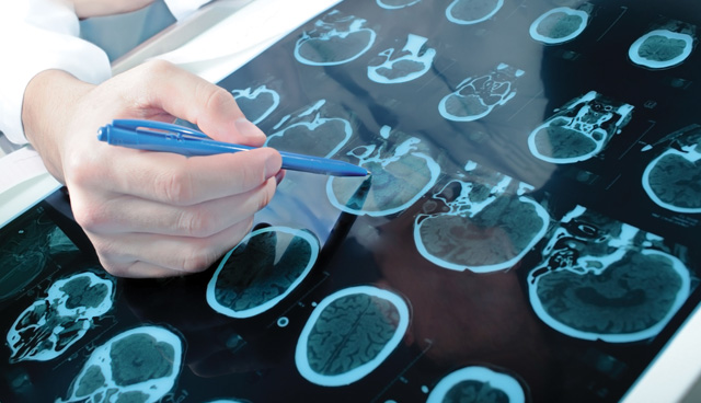 Neurology Review Flags Long Waiting Lists After Largest Patient Recall